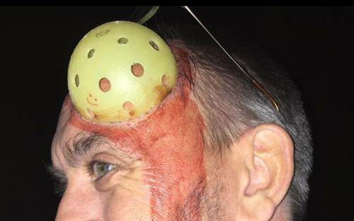Staged costume photo - a pickleball 'stuck' to a player's forehead as a joke